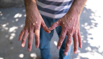 Man with blisters on his hands from monkeypox. File pic: iStock