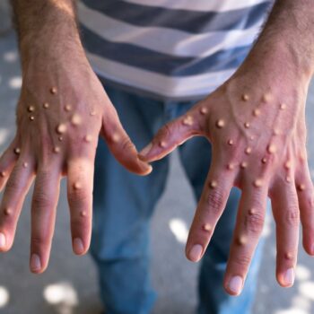 Man with blisters on his hands from monkeypox. File pic: iStock