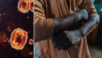 First known case of rare mpox strain confirmed in United States