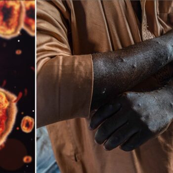 First known case of rare mpox strain confirmed in United States