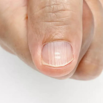 Ce que les ongles striés disent sur la santé et le bon fonctionnement du corps