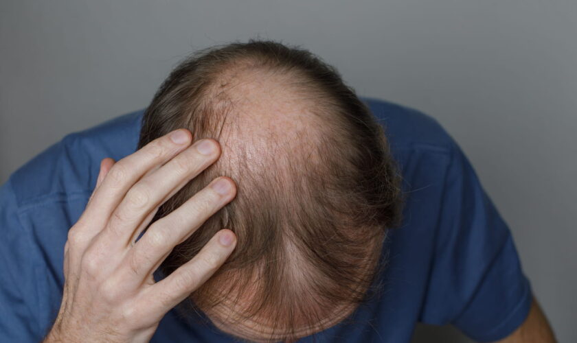 Ce traitement contre la perte de cheveux chez l'homme fonctionne mieux que les autres