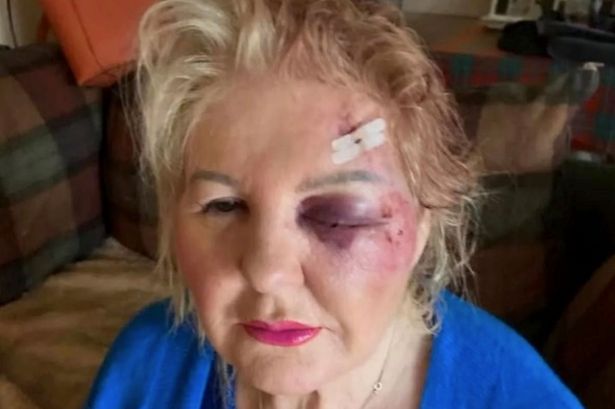 'I've been left partially blind after trip and fall - it nearly killed me'