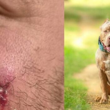 Man recounts terrifying attack by XL bully as police report dog is still on the loose