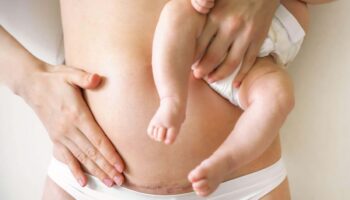 5 myths and misconceptions about caesareans everyone needs to stop believing