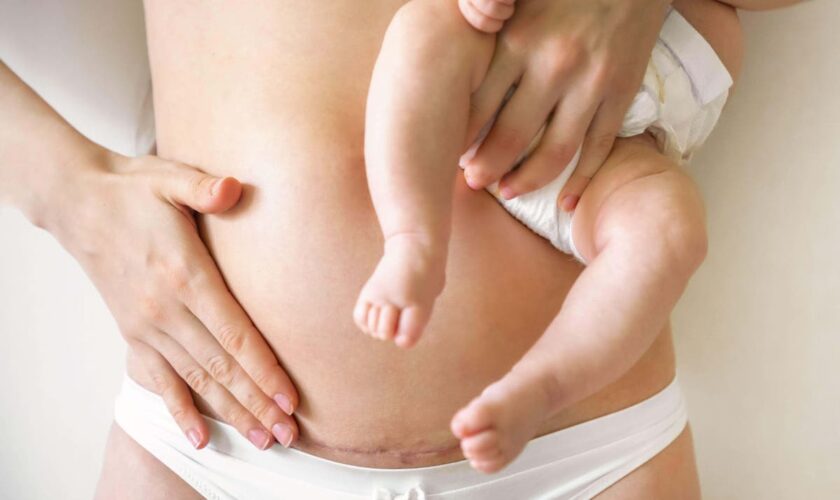 5 myths and misconceptions about caesareans everyone needs to stop believing