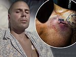 Max George gives update from his hospital bed after his veins collapse during terrifying 2.5 hour emergency heart surgery