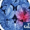 Algorithm could help prevent thousands of strokes in UK each year