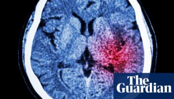 Algorithm could help prevent thousands of strokes in UK each year