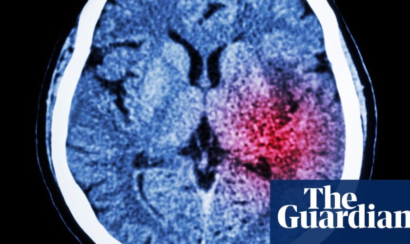 Algorithm could help prevent thousands of strokes in UK each year