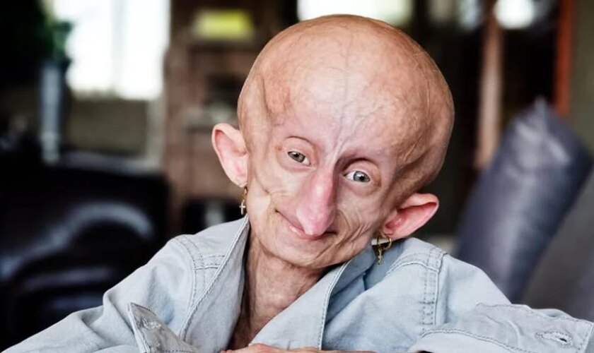 Muere a los 19 años la influencer Beandri Booysen, enferma de progeria