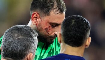 PSG : les images de la balafre de Gianluigi Donnarumma, blessé par le Monégasque Wilfried Singo