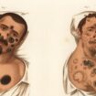 Syphilis: Did Christopher Columbus bring the STD to Europe?