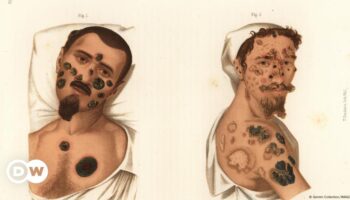 Syphilis: Did Columbus bring the STD to Europe?