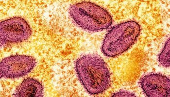 New case of mpox detected in England